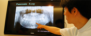 口腔内への配慮、なるべく歯を抜かない矯正治療