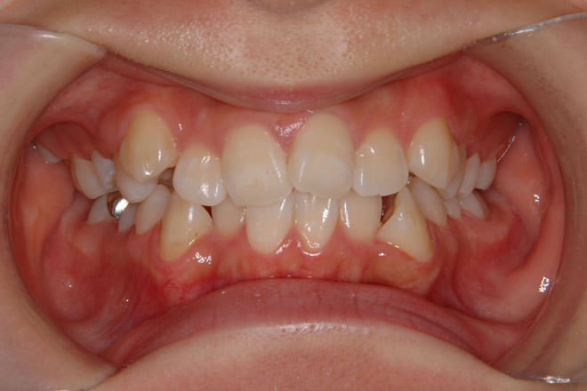 デコボコ歯のイメージ