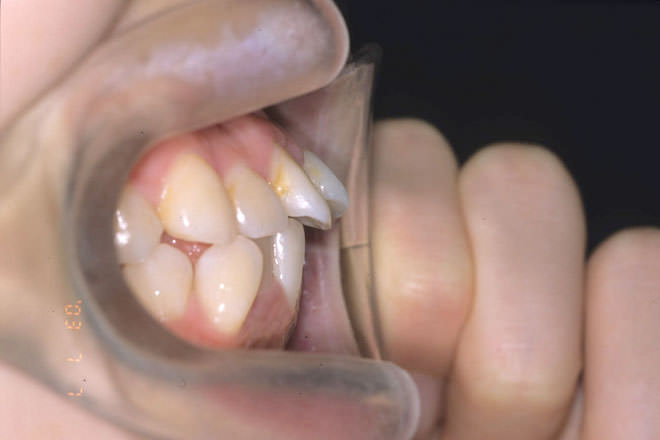 口元が出ている歯のイメージ