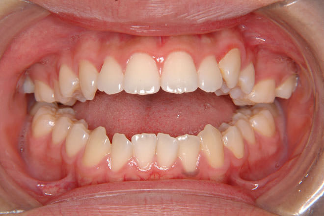 前歯で咬めない