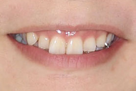 ガミースマイル（笑うと歯茎が見える）