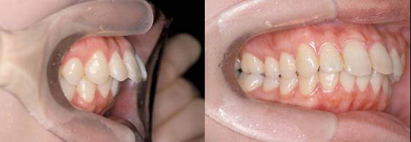 歯を抜かずに治した治療例