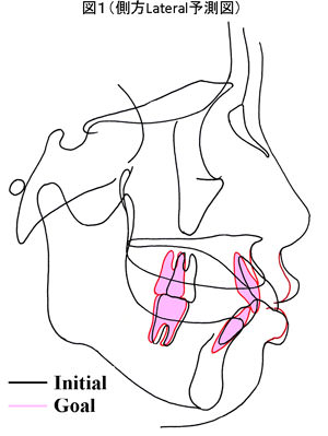 側方Lateral予測図